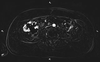 Bilateral adrenal myelolipoma (Radiopaedia 63058-71537 I 69).jpg