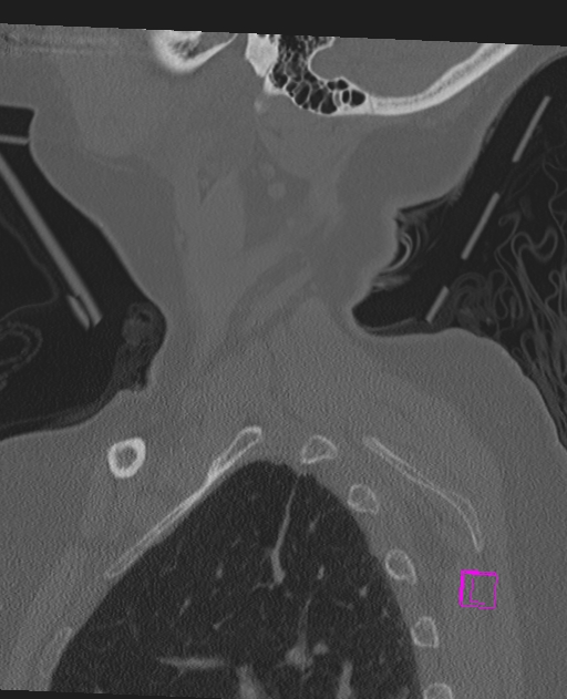Bilateral atlanto-occipital assimilation (Radiopaedia 28350-28603 Sagittal bone window 7).jpg