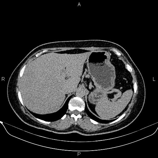Bilateral benign adrenal adenomas (Radiopaedia 86912-103124 Axial C+ delayed 19).jpg