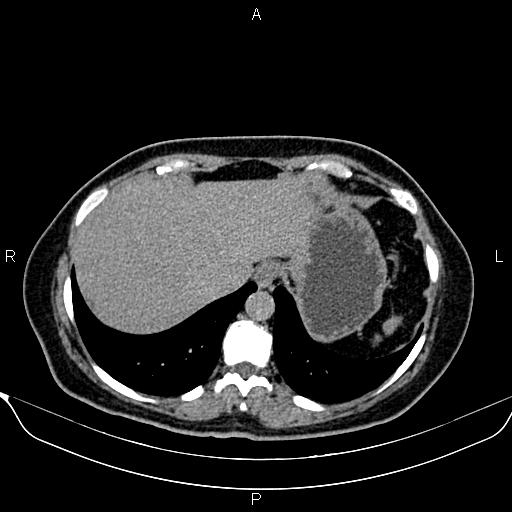 Bilateral benign adrenal adenomas (Radiopaedia 86912-103124 Axial C+ delayed 4).jpg