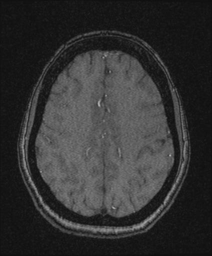 Bilateral carotid body tumors and right glomus jugulare tumor (Radiopaedia 20024-20060 Axial MRA 137).jpg