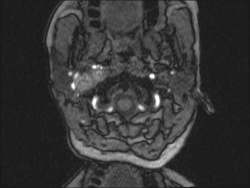 Bilateral carotid body tumors and right glomus jugulare tumor (Radiopaedia 20024-20060 Axial MRA 291).jpg