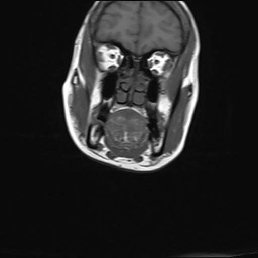 File:Bilateral carotid body tumors and right jugular paraganglioma (Radiopaedia 20024-20060 Coronal 11).jpg