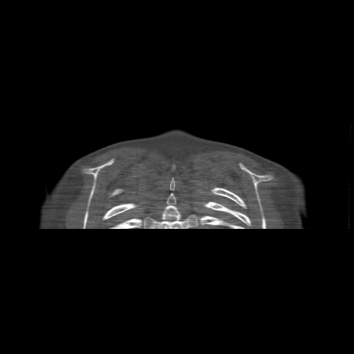 Bilateral chronic posterior shoulder dislocation (Radiopaedia 39213-41452 Coronal bone window 58).jpg