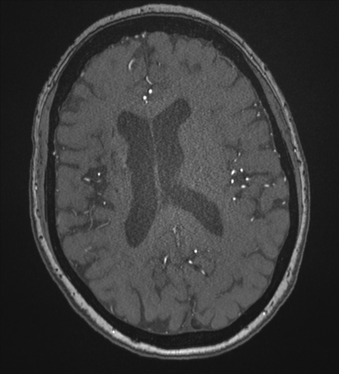 Bilateral fetal posterior communicating arteries (Radiopaedia 41286-44102 Axial MRA 133).png