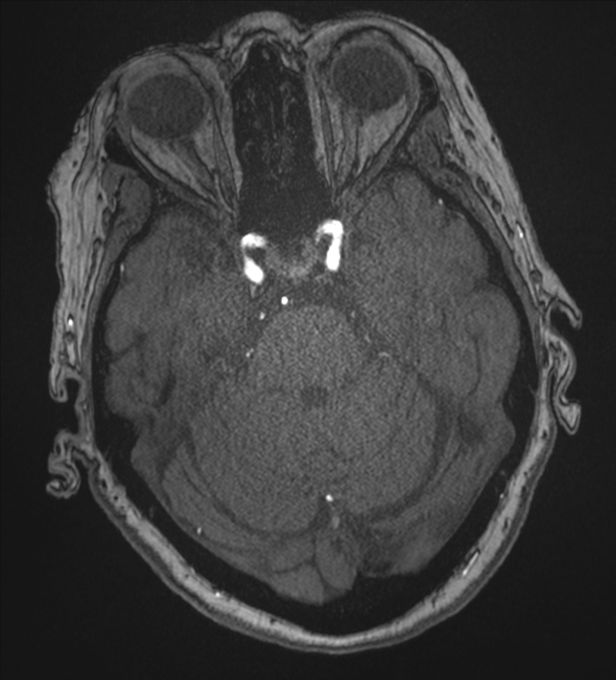 Bilateral fetal posterior communicating arteries (Radiopaedia 41286-44102 Axial MRA 61).png