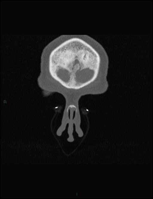 Bilateral frontal mucoceles (Radiopaedia 82352-96454 Coronal 35).jpg