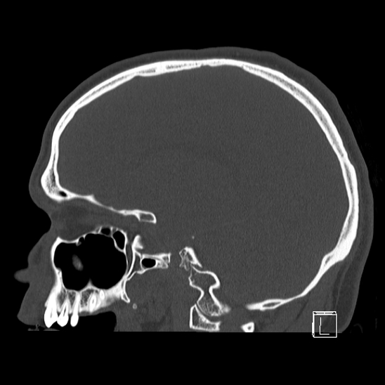 Bilateral occipital condyle fracture (type 2) (Radiopaedia 87675-104089 Sagittal bone window 41).jpg