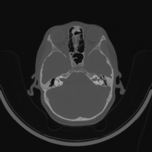 Bilateral otosclerosis (Radiopaedia 57237-64157 C 51).jpg