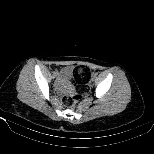 File:Bilateral ovarian dermoid (Radiopaedia 45714-49907 Axial non-contrast 26).JPEG