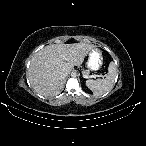 Bilateral ovarian dermoid cysts (Radiopaedia 85785-101603 A 26).jpg