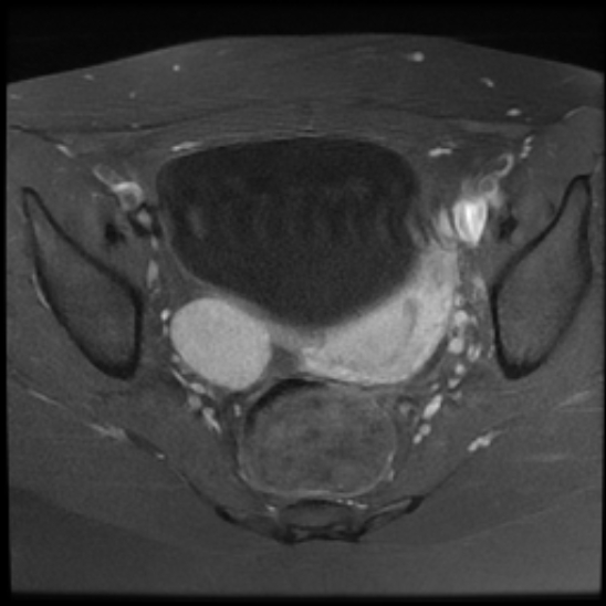 File:Bilateral ovarian fibrothecomas - adolescent (Radiopaedia 86604-102707 Axial T1 C+ fat sat 17).jpg