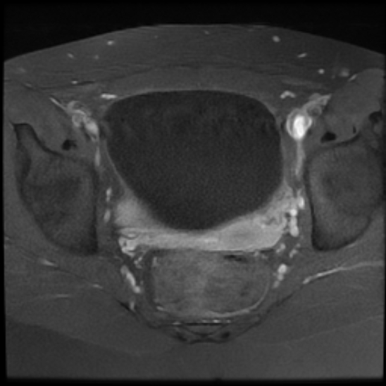 File:Bilateral ovarian fibrothecomas - adolescent (Radiopaedia 86604-102707 Axial T1 C+ fat sat 19).jpg