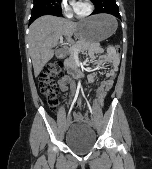 File:Bilateral ovarian mature cystic teratomas (Radiopaedia 79373-92457 B 25).jpg