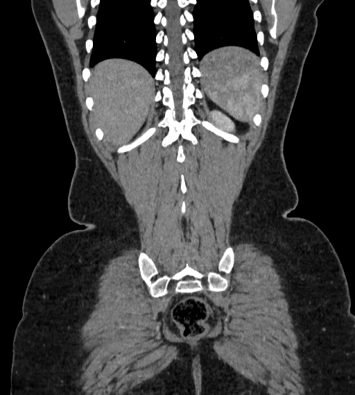 Bilateral ovarian mature cystic teratomas (Radiopaedia 79373-92457 B 93).jpg