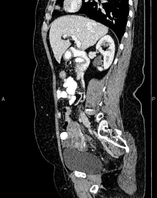 Bilateral ovarian serous cystadenocarcinoma (Radiopaedia 86062-101989 E 30).jpg