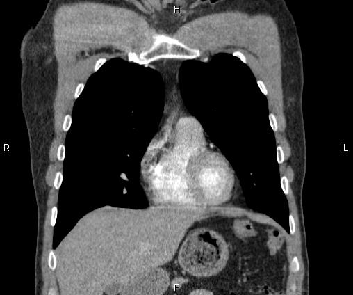 Bilateral pulmonary AVM (Radiopaedia 83134-97505 C 23).jpg