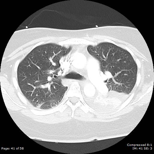 Bilateral pulmonary emboli with Hampton hump sign (Radiopaedia 54070-60246 Axial lung window 41).jpg