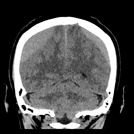 Bilateral subacute subdural hematoma (Radiopaedia 69240-79018 Coronal non-contrast 41).jpg