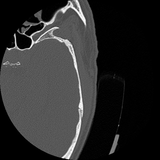 Bilateral temporal bone fractures (Radiopaedia 29482-29970 D 145).jpg