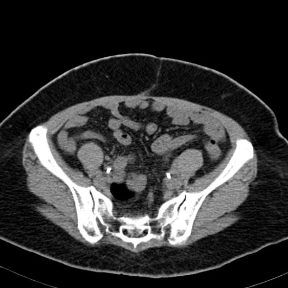 Bilateral ureteric stents (Radiopaedia 48795-53825 Axial non-contrast 48).jpg