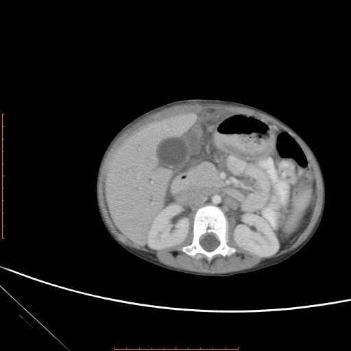 Biliary tract embryonal rhabdomyosarcoma (Radiopaedia 51815-57648 A 56).jpg