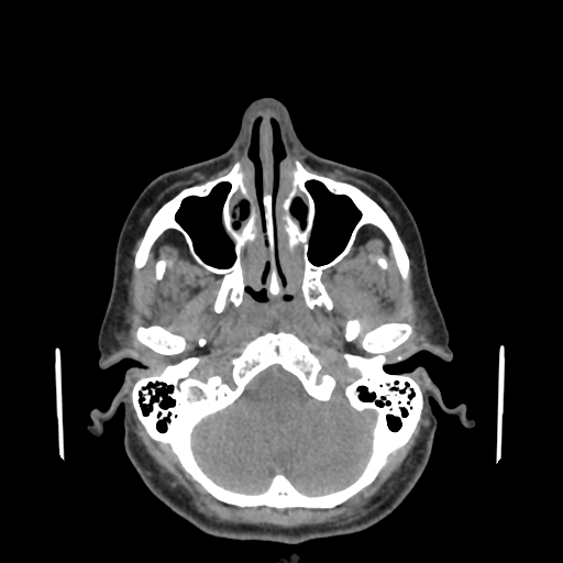 File:Bisphosphonate-related osteonecrosis of the jaw (Radiopaedia 71324-81642 non-contrast 144).jpg