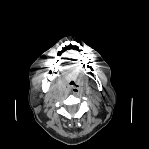 File:Bisphosphonate-related osteonecrosis of the jaw (Radiopaedia 71324-81642 non-contrast 76).jpg