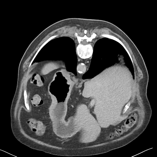 File:Bladder papillary urothelial carcinoma (Radiopaedia 48119-52951 Axial C+ delayed 2).png