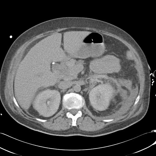 File:Bladder rupture post renal biopsy (Radiopaedia 30863-31572 Axial non-contrast 32).jpg
