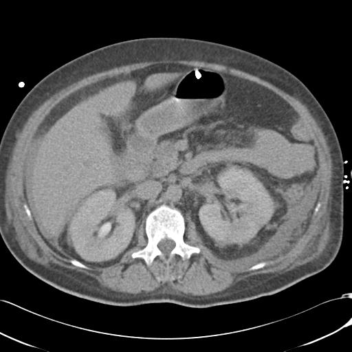 Bladder rupture post renal biopsy (Radiopaedia 30863-31572 Axial non-contrast 35).jpg