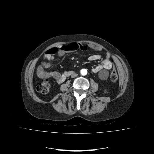 File:Bladder tumor detected on trauma CT (Radiopaedia 51809-57609 A 124).jpg