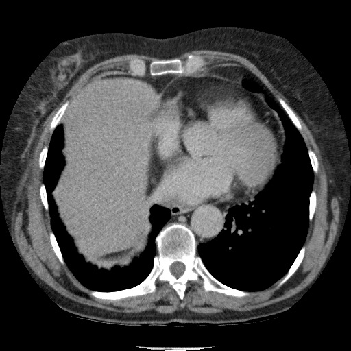 Bladder tumor detected on trauma CT (Radiopaedia 51809-57609 C 9).jpg