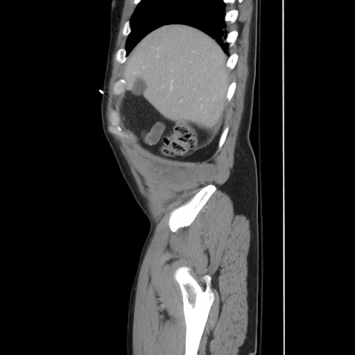 File:Blunt abdominal trauma with solid organ and musculoskelatal injury with active extravasation (Radiopaedia 68364-77895 C 33).jpg