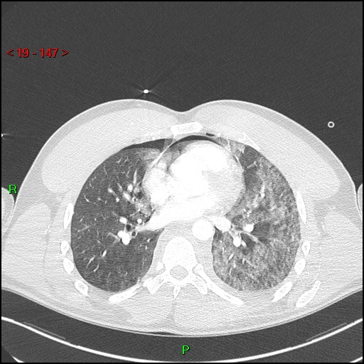 Blunt thoracic trauma (Radiopaedia 73454-84221 Axial lung window 54).jpg
