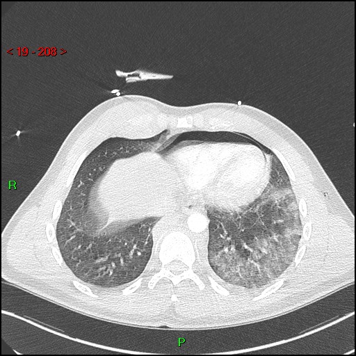 Blunt thoracic trauma (Radiopaedia 73454-84221 Axial lung window 77).jpg