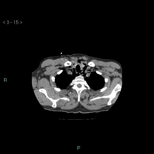 File:Boerhaave syndrome (Radiopaedia 27683-27897 Axial non-contrast 15).jpg