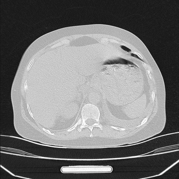 Boerhaave syndrome (Radiopaedia 45644-49799 Axial lung window 99).jpg