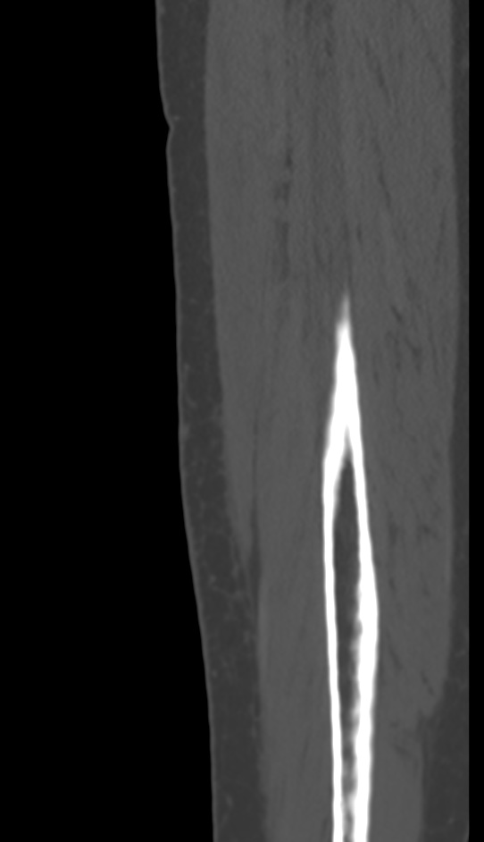 Bone metastasis - tibia (Radiopaedia 57665-64609 Sagittal bone window 158).jpg