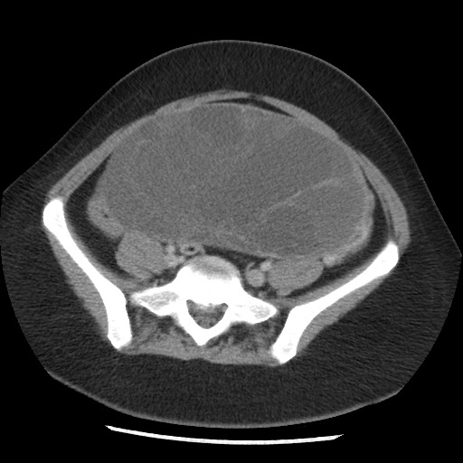 File:Borderline mucinous tumor (ovary) (Radiopaedia 78228-90808 A 111).jpg