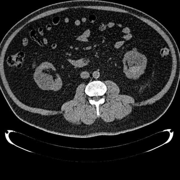 Bosniak renal cyst - type IV (Radiopaedia 24244-24518 Axial non-contrast 161).jpg