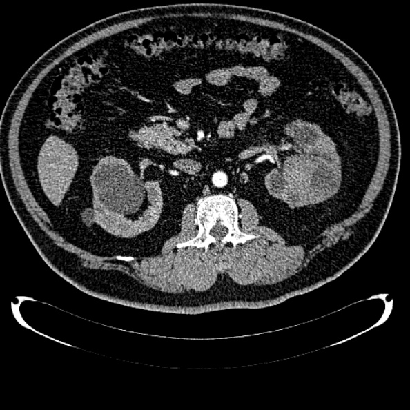 Bosniak renal cyst - type IV (Radiopaedia 24244-24518 B 144).jpg