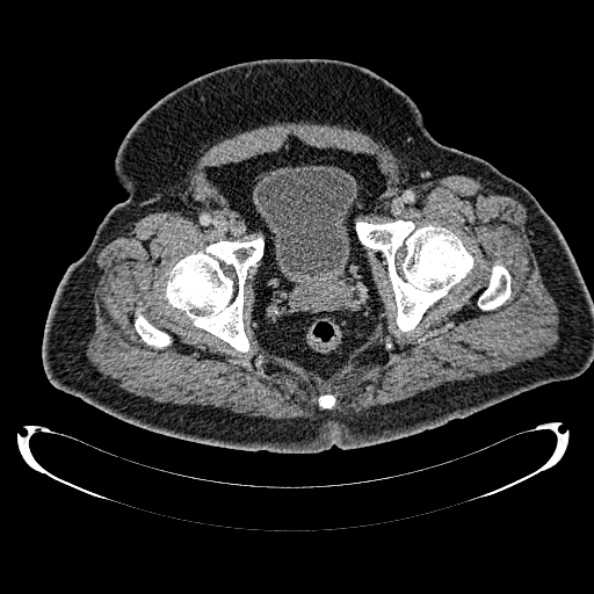 Bosniak renal cyst - type IV (Radiopaedia 24244-24518 C 332).jpg
