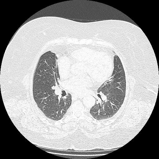 Bovine aortic arch - right internal mammary vein drains into the superior vena cava (Radiopaedia 63296-71875 Axial lung window 87).jpg