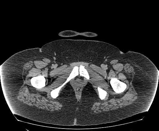 Bowel and splenic infarcts in acute lymphocytic leukemia (Radiopaedia 61055-68913 A 128).jpg
