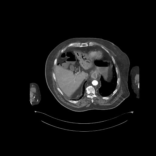 File:Bowel ischemia secondary to SMA occlusion with extensive portomesenteric venous gas (Radiopaedia 54656-60871 A 65).jpg