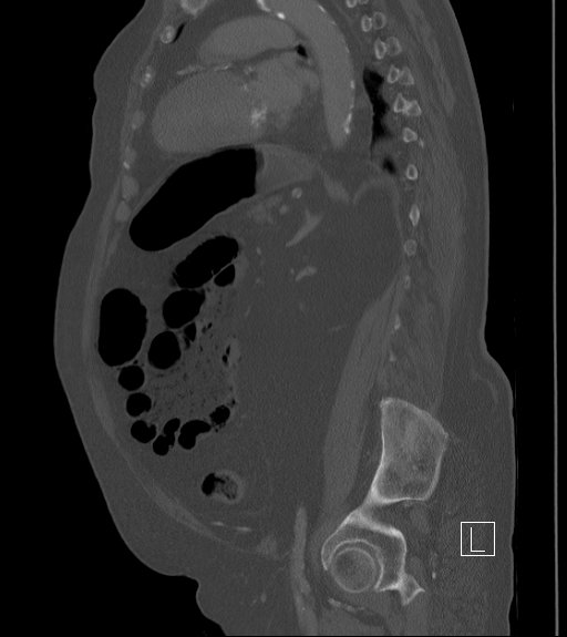File:Bowel ischemia secondary to SMA occlusion with extensive portomesenteric venous gas (Radiopaedia 54656-60871 Sagittal bone window 38).jpg