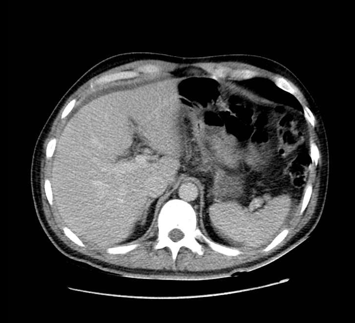 Bowel obstruction from colon carcinoma (Radiopaedia 22995-23028 A 17).jpg