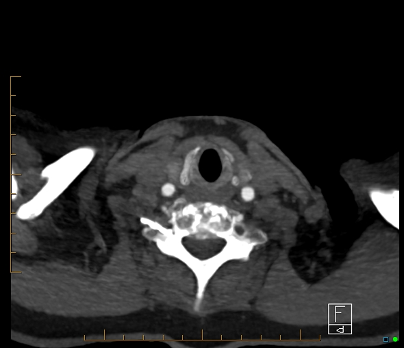 Brachiocephalic trunk stenosis (Radiopaedia 87242-103519 A 112).jpg