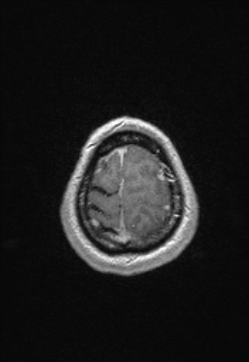Brain abscess with ventriculitis (Radiopaedia 85703-101495 Axial T1 C+ 153).jpg
